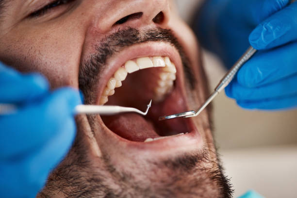Best Emergency Dentist for Knocked-Out Tooth in North Tustin, CA